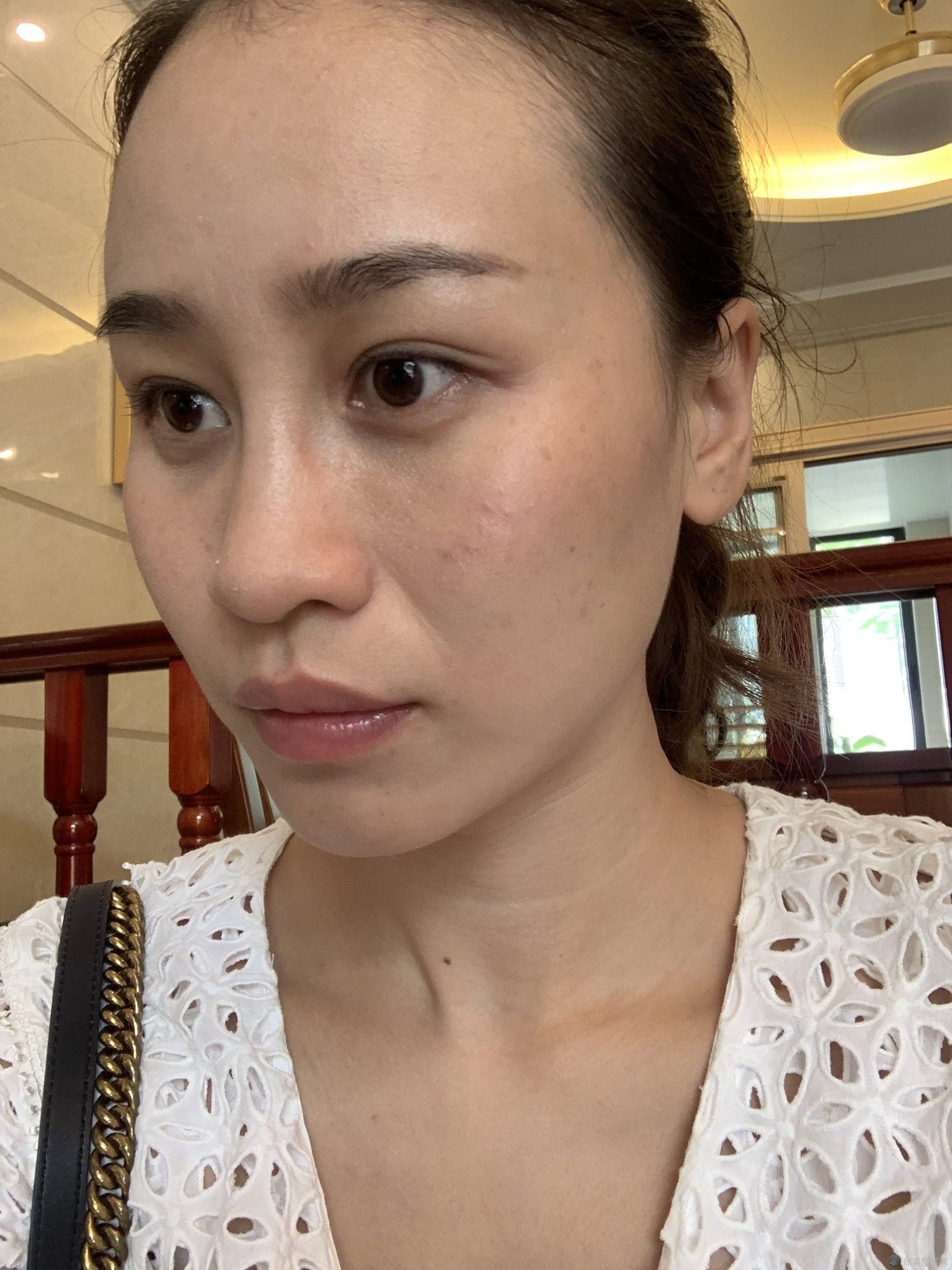 河南哪家医院做激光去眼袋靠谱？当属臻美、科技大学、妇幼保健院这三家!价