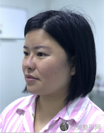 烟台美神医疗美容整形医院穆宝安做吸脂怎么样？附医生简介-吸脂案例及价格