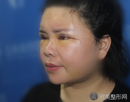 烟台美神医疗美容整形医院穆宝安做吸脂怎么样？附医生简介-吸脂案例及价格