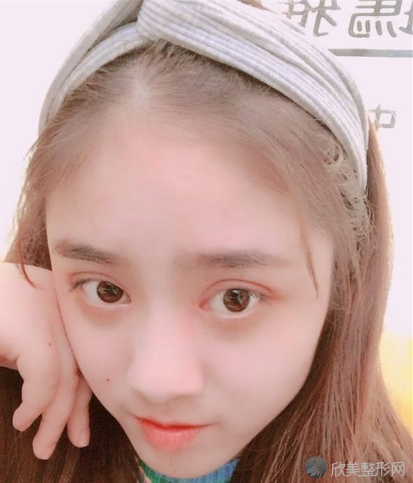 淮北时光医疗美容门诊部刘慧做开眼角怎么样？附医生简介-开眼角案例及价格