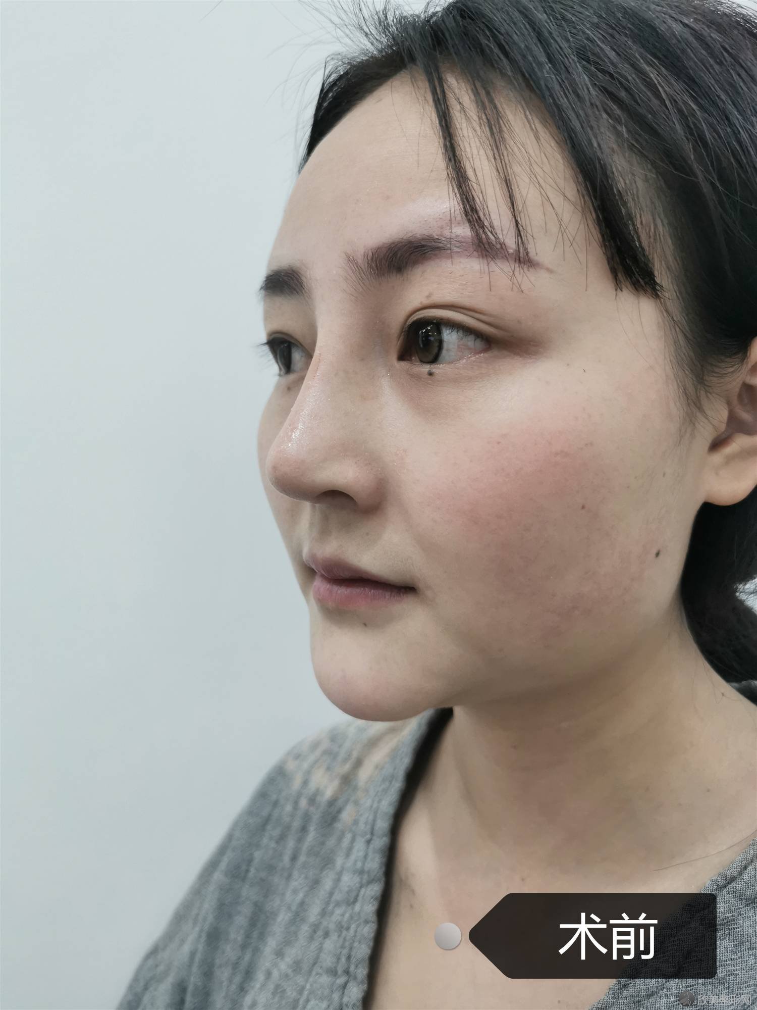 黔西南哪家医院做鼻小柱延长比较靠谱？正规排名榜盘点前四-价格清单一一出