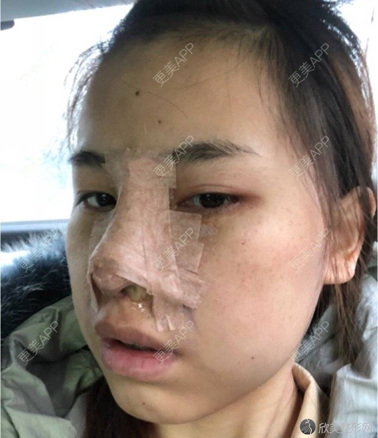 黔西南哪家医院做鼻小柱延长比较靠谱？正规排名榜盘点前四-价格清单一一出