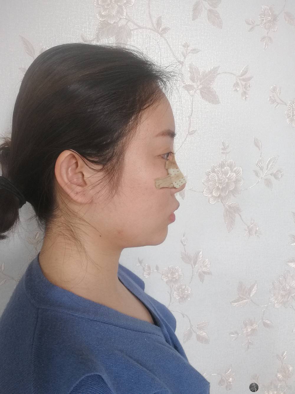 贵阳利美康植发王昌林做鼻骨矫正怎么样？附医生简介|鼻骨矫正案例及价格表