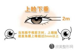 上睑下垂矫正手术多久可以完全恢复