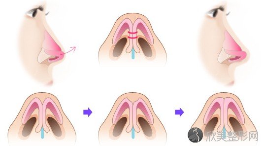 重庆做硅胶假体隆鼻术后鼻子会透光?