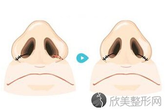 广州硅胶假体隆鼻价格
