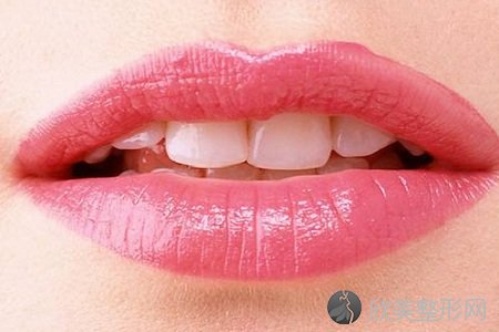 丰唇可以维持多久 丰唇手术方法有哪些