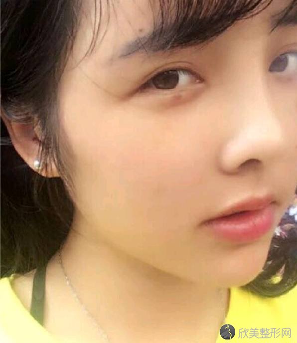 宁波静港整形廖柏臣做自体脂肪面部填充怎么样？附医生简介-自体脂肪面部填
