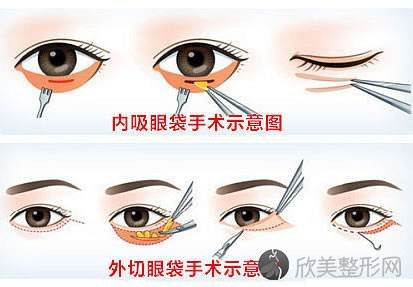 深圳美莱祛除眼袋的更好办法是什么？