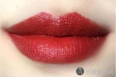成都玻尿酸丰唇多少钱
