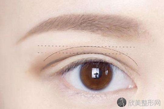 郑州美莱双眼皮修复为什么比割双眼皮贵？