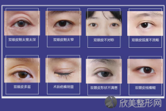 郑州美莱双眼皮修复为什么比割双眼皮贵？