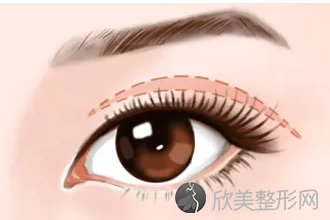 郑州美莱医院双眼皮修复的怎么样？