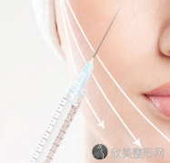 贵阳填充法令纹用玻尿酸效果好吗