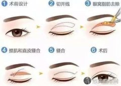 杭州做切开双眼皮术后容易恢复吗