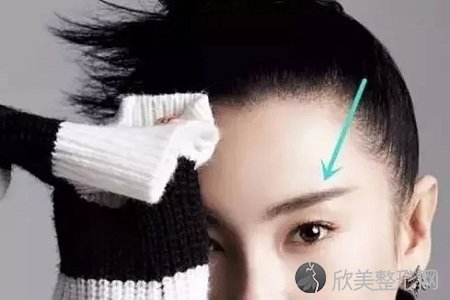 郑州眉毛种植方法有哪些 效果堪比整容