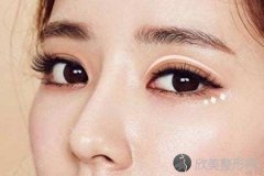 西安美莱开眼角多少钱