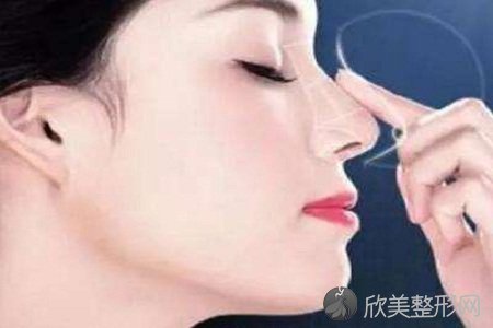 北京玻尿酸隆鼻手术多少钱