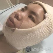 冯光V-LINE瓜子脸手术案例_术后340天手术效果