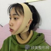杨海皎V-LINE瓜子脸手术案例_术后310天效果图