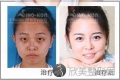 激光祛斑后会变麻子脸吗