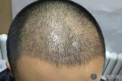 郑州美莱头发种植之术后常见问题（三）