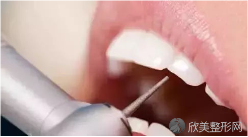 郑州美莱整形怎么治疗牙齿缺损