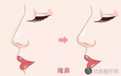 郑州美莱整形医院隆鼻有几种、效果怎么样？