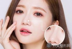 长沙美莱驼峰鼻矫正术多少钱