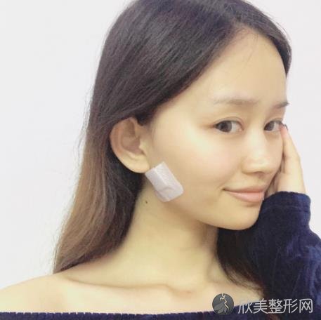 上海长海医院整形科做面部除皱案例+价格价目表在线更新了！