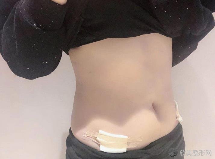 天津华美整形美容医院怎么样？2024腰腹吸脂案例[价格]在线查询