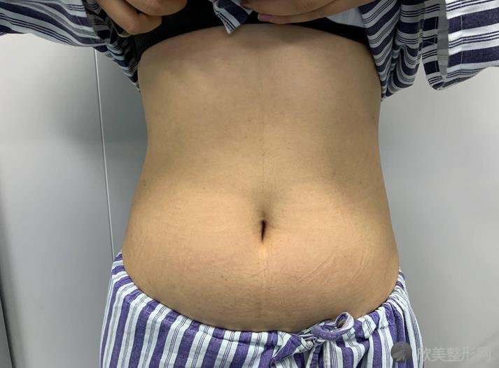 天津华美整形美容医院怎么样？2024腰腹吸脂案例[价格]在线查询