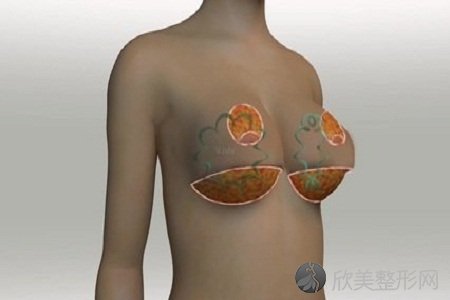 重庆做假体隆胸手术费用是多少
