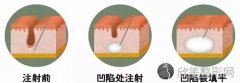 玻尿酸的正确使用方式是怎样的