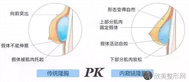 内窥镜隆胸PK传统隆胸，究竟好在哪？看完就知道！