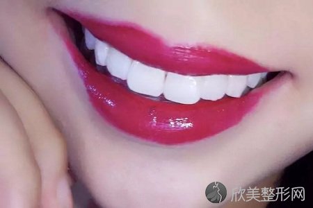 重庆做冷光牙齿美白整形有副作用吗