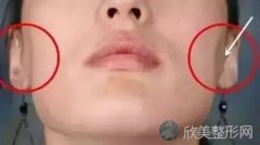 不敢打水光针？担心打完脸颊凹？