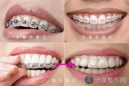 北京做牙齿矫正有哪些方法