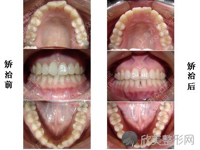 畸形牙在上海矫正牙齿要多久