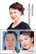 如何祛除老年斑