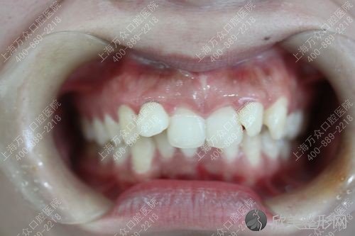 孕妇牙齿不齐会遗传吗