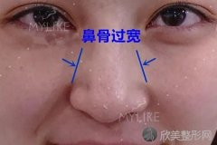 侧面看鼻梁不矮,正面看鼻子却很塌是什么原因？