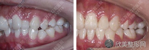牙齿矫正：牙齿拥挤的终极治疗方法 