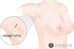 假体隆胸的三种切口应该怎样选择