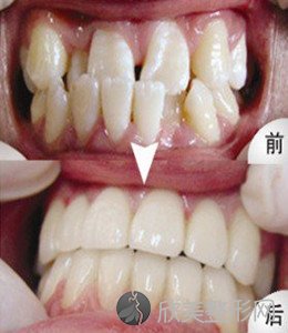 牙齿不整齐进行矫正的步骤都有哪些 牙齿矫正效果图