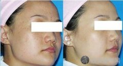 医学美容如何实现轻松消除妊娠斑