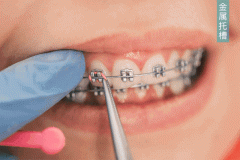 牙齿矫正即整容，这科学吗？
