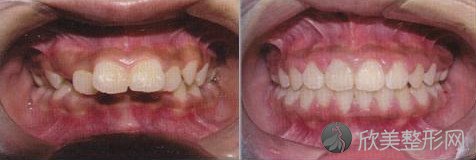 牙齿矫正一般有几种方法