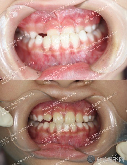 高难度儿童龅牙矫正治疗