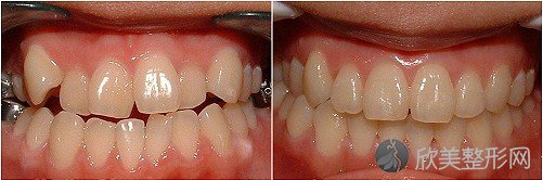 成人牙齿矫正能否快速进行 较快几天